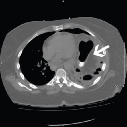 Incarcerated Diaphragmatic Hernia with Bowel Perforation Presenting as ...