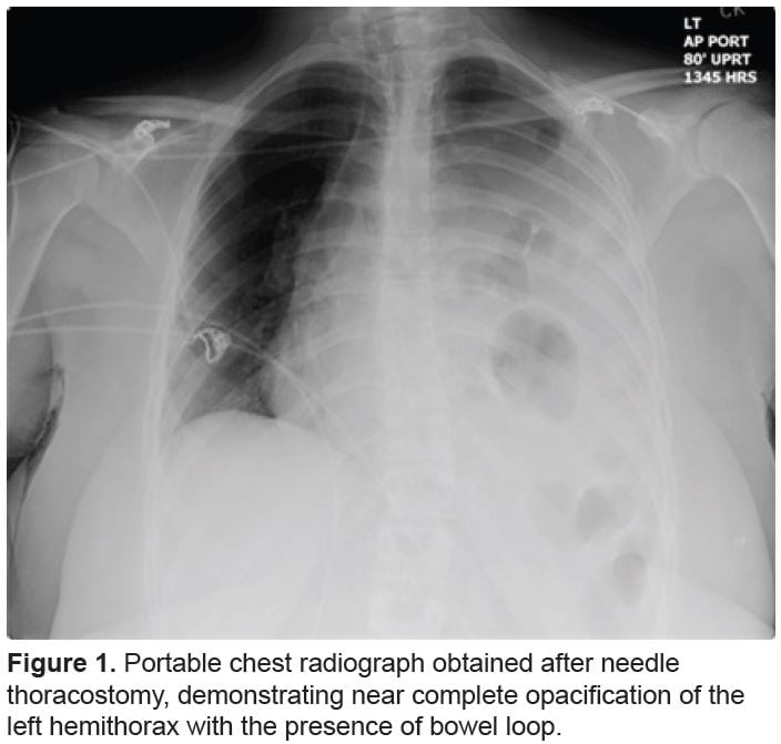 Incarcerated Diaphragmatic Hernia with Bowel Perforation Presenting as a Tension Pneumothorax