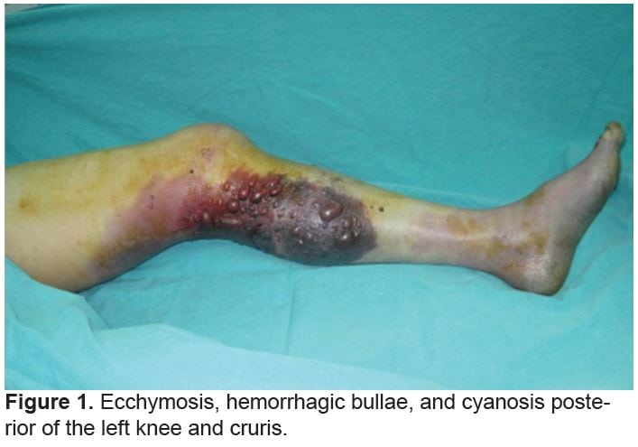 Popliteal Artery Injury Associated with Blunt Trauma to the Knee without Fracture or Dislocation