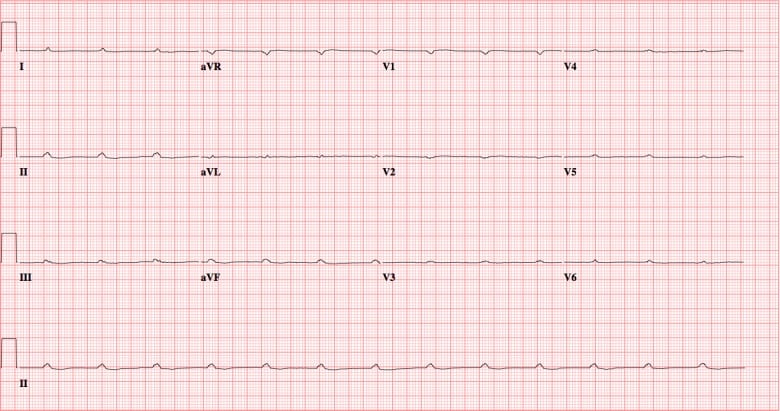 Complete Ventricular Asystole in a Patient with Altered Mental Status
