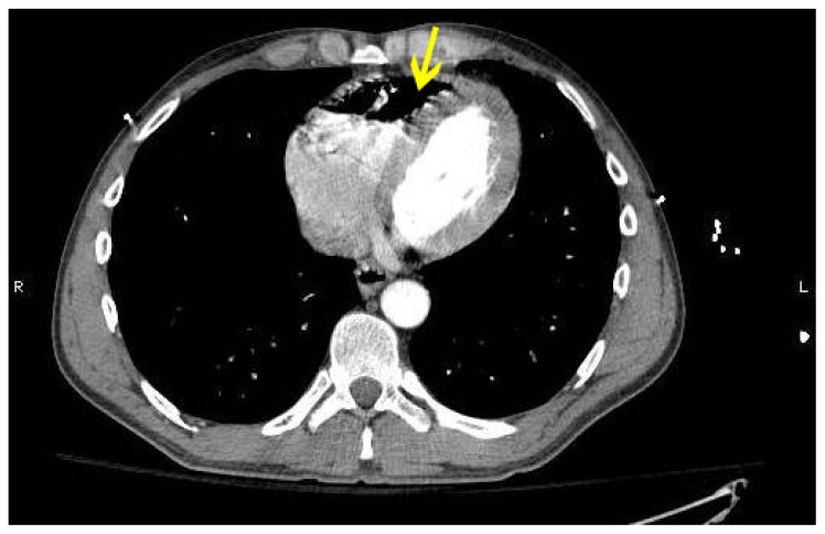 Figure 2 Computed tomography of the thorax with intravenous contrast demonstrates a large right ventricular air embolus.