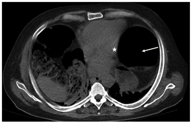 Figure 2 Dilated bowel (solid arrow) compressing the left atrium (star) and lungs.