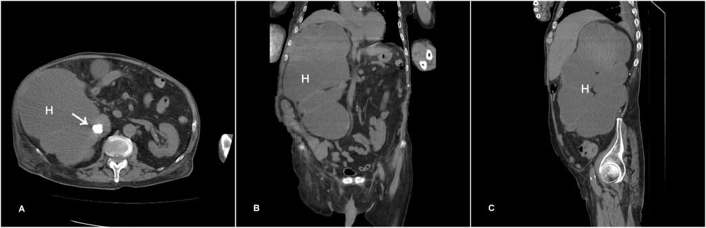Figure 1 Dilated bowel (solid arrow) compressing the left atrium and lungs. Dilated colon contains stool and gas (dashed arrow).