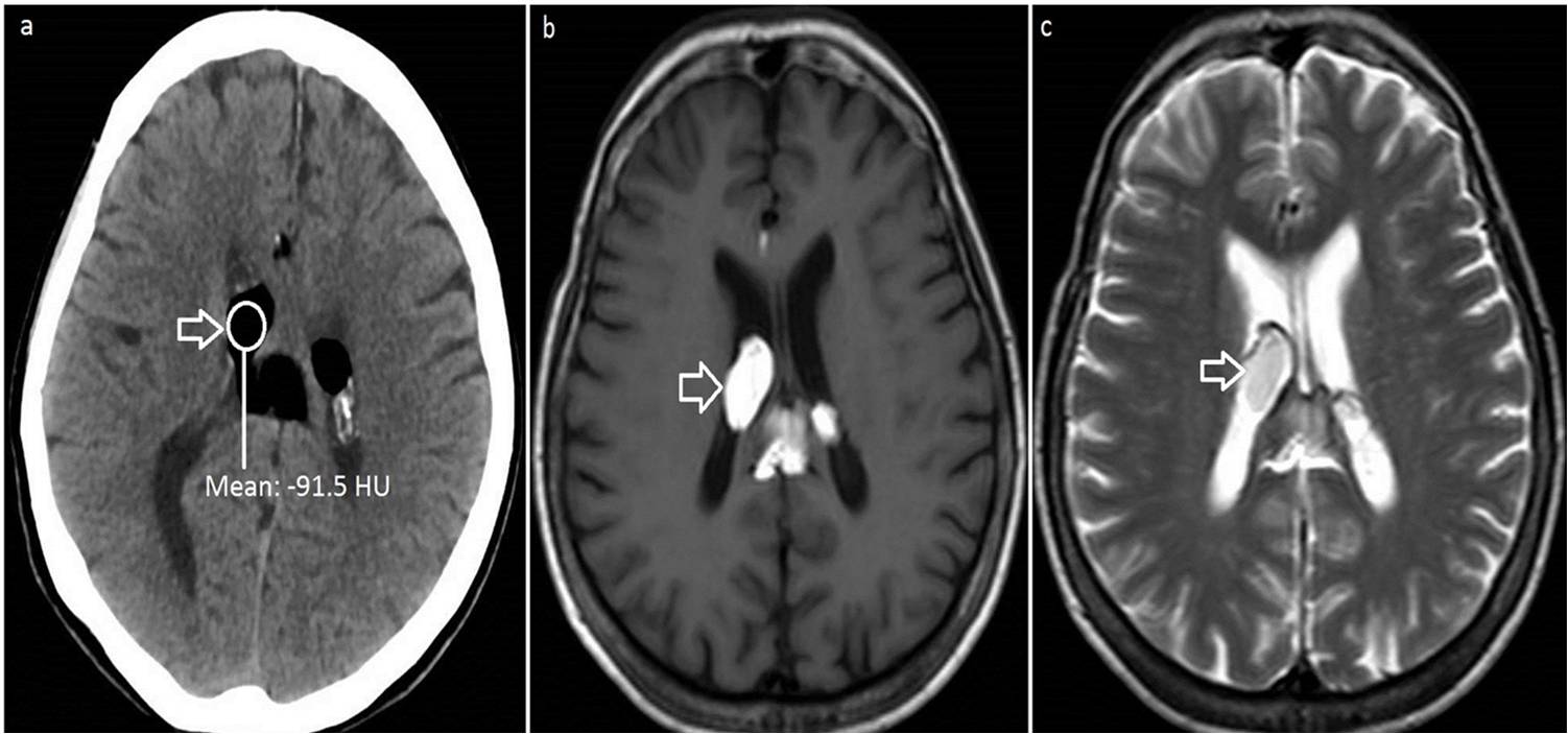 Figure Image (a) shows cranial computed tomography. There is a homogenously hypodense lesion measuring 33 mm × 30 mm in the lateral and third ventricles with about −101 to −110 Hounsefield unit. Image (b) and (c) show magnetic resonance imaging with hyperintense mass lesion in lateral ventricle (T1-weighted and T2-weighted images, respectively).