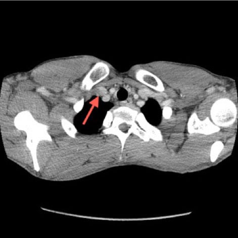 Thoracic Outlet Syndrome with Secondary Paget Schröetter Syndrome: A Rare Case of Effort-Induced Thrombosis of the Upper Extremity