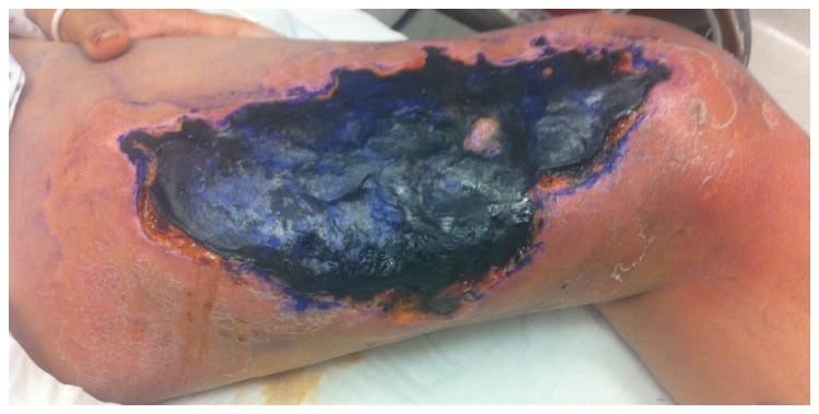 Figure A purple ulcer on the left medial thigh.