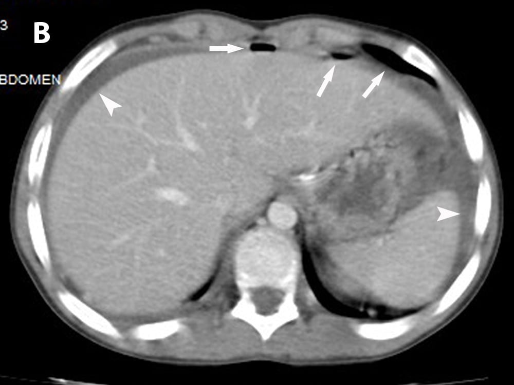 Figure A Axial computed tomography demonstrates the anterior abdominal wall defect and the herniated small bowel segment (arrow) with segmental ileus presented as dilatation of small bowel (*). B. Pneumoperitoneum (arrows) and free peritoneal fluid around the liver and spleen (arrowheads).