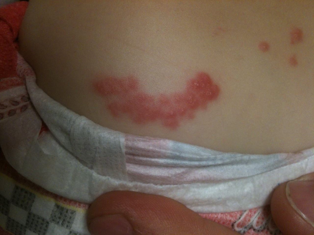 Figure 1 Classic dermatomal distribution of vesicular rash extending from the left lumbar back to the left anterolateral thigh.