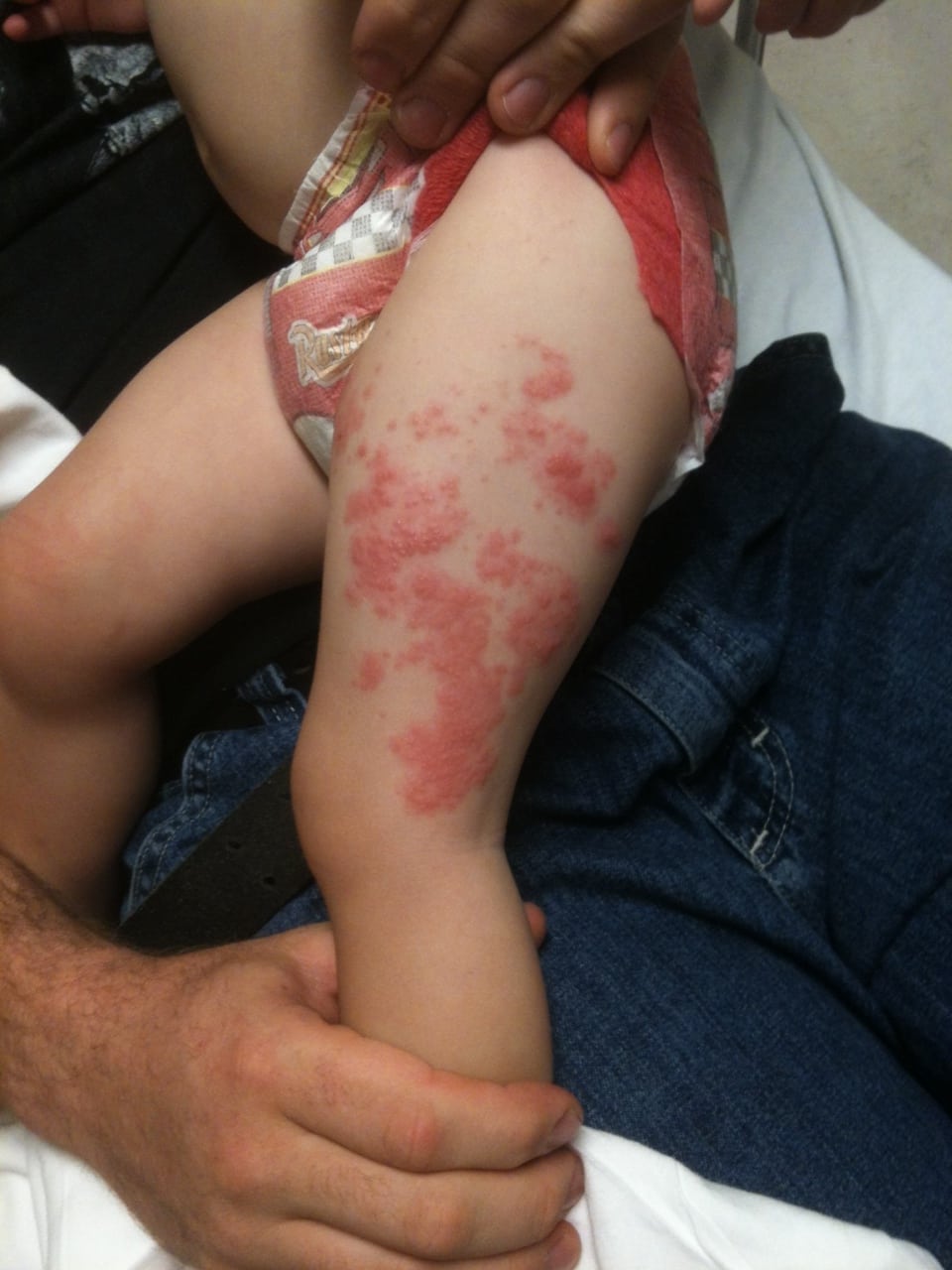 Figure 2 Classic dermatomal distribution of vesicular rash extending from the left lumbar back to the left anterolateral thigh.