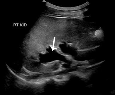 Figure 1 Longitudinal view of the right kidney showed moderate hydroureteronephrosis (arrow).