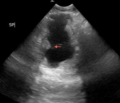 Figure 2 Transverse view of the bladder shows a small, irregularly shaped bladder wall with areas of focal thickening (arrow).