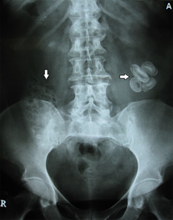 Figure 1 Radiography of the abdomen revealing radio-opaque shadows (arrowheads).