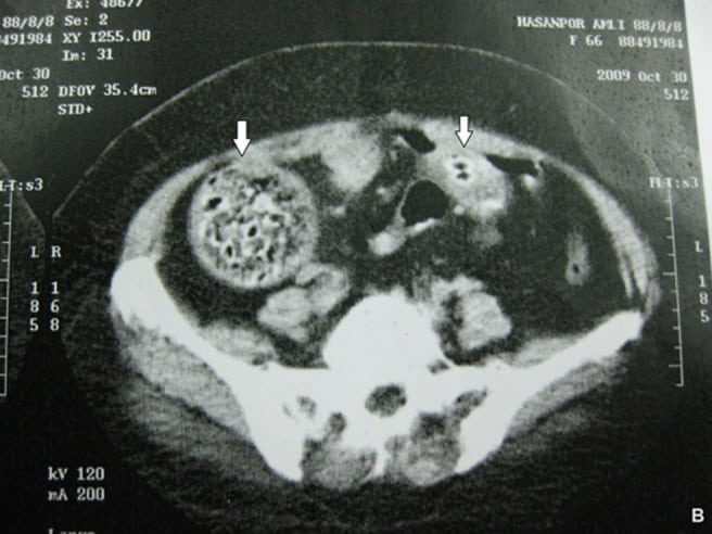 Figure 2 Contrast-enhanced abdominal computed tomography transverse image showing round calcified mass with areas of air (arrows).