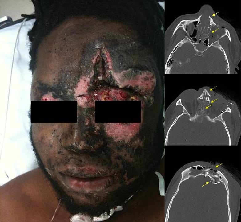 Figure 3 Patient 4 upon presentation with computed tomography of the head (axial view). Multiple facial fractures (arrows).