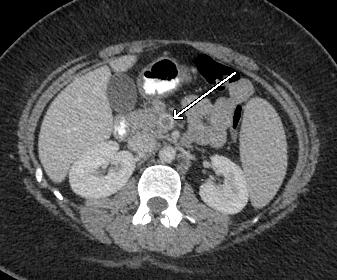Figure Computed tomography of the abdomen showing a large filling defect in the superior mesenteric vein (arrow) indicating the presence of thrombus.