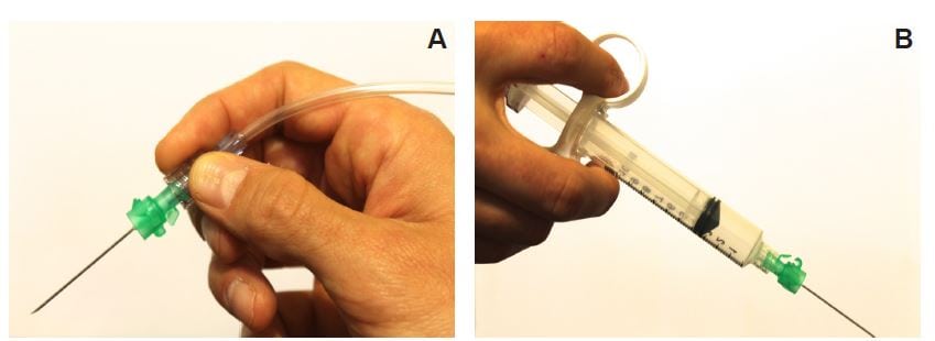 Figure 1 A, Hand-on-needle technique has the provider holding the needle hub in a pencil-like fashion while resting their hand on the body surface. B, Hand-on-syringe technique has the operator hold the syringe rather than the needle, enabling them to aspirate and inject local anesthetic without the use of an assistant.