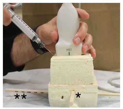 Figure 3 Difficult phantom model with hand-on-syringe approach. The simulated phantom model employed two sections of extra-firm tofu (10 by 8 by 4cm). Two wooden dowels were inserted through the tofu in perpendicular orientation to reflect a modeled nerve (*) and vessel (**). The modeled vessel was deeper and adjacent to the modeled nerve.