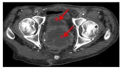 Figure 1 Axial computed tomography demonstrates persistent abscess within the bladder and prostate after spontaneous urethral drainage, with communication between the bladder (B) and prostate (P) abscesses.