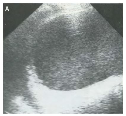 Figure 2 Sagittal ultrasound of the bladder in a patient with pyocystis reveals complex heterogeneous fluid within the urinary bladder. Reprinted with permission, courtesy Elsevier from Tung and Papanicolaou. J Can Assoc Radiol. 1990.