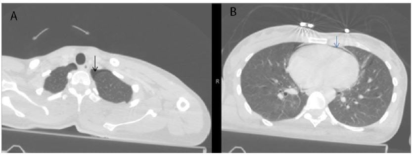 Figure 1 Thoraco-abdominal computed tomography showing pneumothorax, A, and pneumopericardium, B.