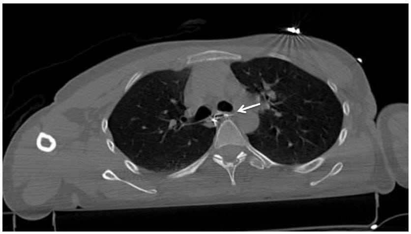 Figure 2 Thoracic computed tomography with oral contrast enhancement showing extraluminal contrast material from the esophagus.