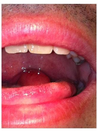 Quincke’s Disease: Isolated Uvulitis