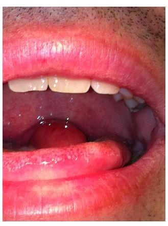 Figure Enlarged uvula.