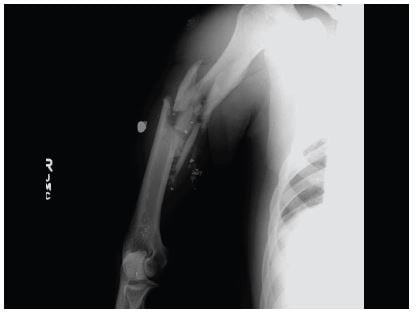 Figure 1 Plain film imaging indicating a comminuted mid-shaft humeral fracture.