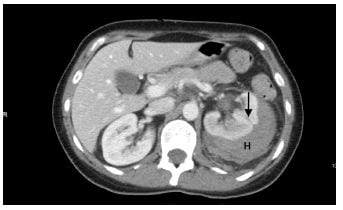 Figure Computed tomography of the abdomen three days following extracorporeal shockwave lithotripsy and laser lithotripsy procedures showing a laceration to the lateral aspect of the mid left kidney (black arrow) and a hematoma on the posterior and lateral borders of the left kidney (H).