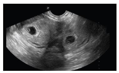 Figure 1 Longitudinal transvaginal ultrasound demonstrating intrauterine pregnancy on the left and the mirror-image artifact on the right of the image.