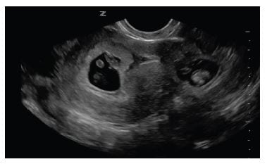 Figure 2 Longitudinal transvaginal ultrasound image yielding intrauterine pregnancy on the left and mirror-image artifact on the right.