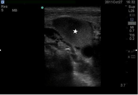 Figure 2 Ultrasound image demonstrating clot in right IJ (star). IJ, internal jugular
