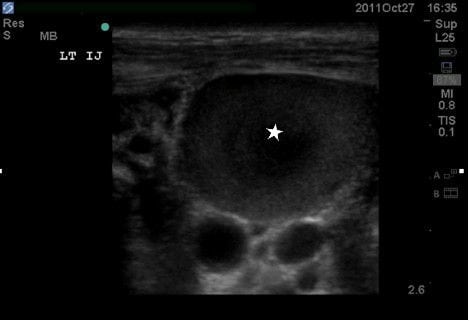 Figure 3 Ultrasound image demonstrating clot in left IJ (star). IJ, internal jugular