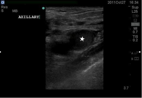 Figure 4 Ultrasound image demonstrating clot in right axillary vein (star).