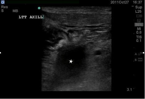 Figure 5 Ultrasound image demonstrating clot in left axillary vein (star).