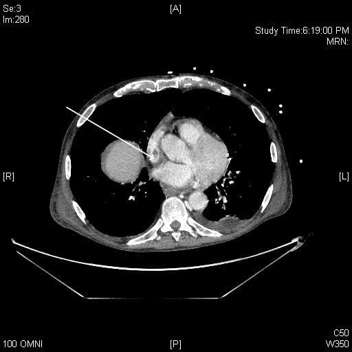 Figure 6 Computed tomography image demonstrating filling defect in SVC distal to central venous port tip (arrow). SVC, superior vena cava