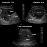 Figure 2. Thickened and hypoechoic bowel wall demonstrating edema (A), free fluid surrounding abnormal bowel (B) and free fluid in Morison’s pouch (C).