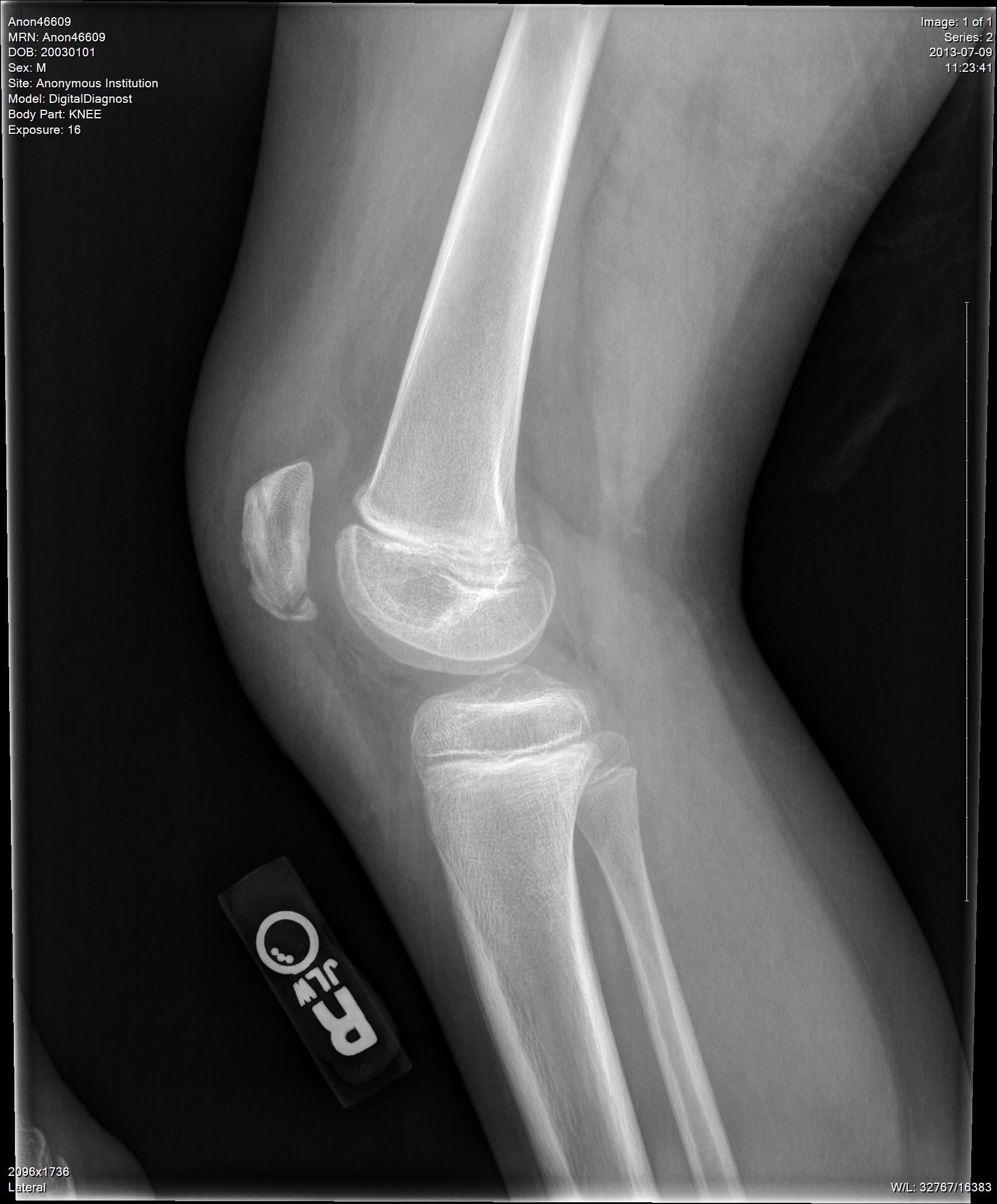 Patella Fracture