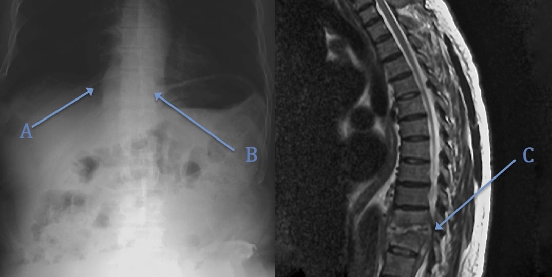 Diagnosis of Spinal Epidural Abscess by  Abdominal Plain-Film Radiography