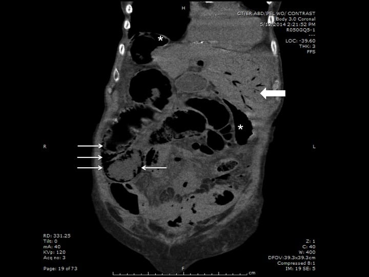 Hepatic Portal Venous Gas: Findings on Ultrasound and CT