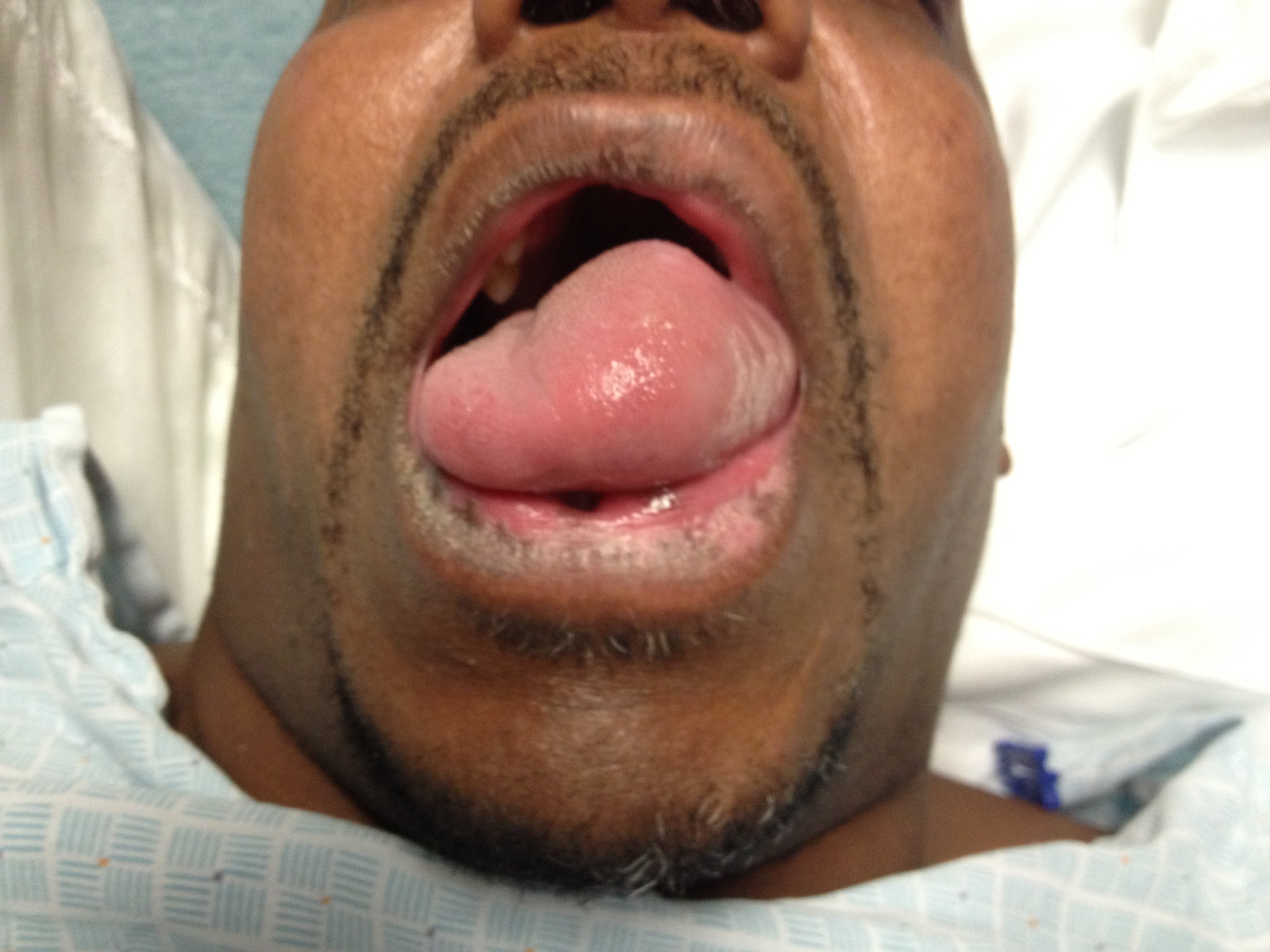 Hemi Orolingual Angioedema After tPA administration for Acute Ischemic Stroke