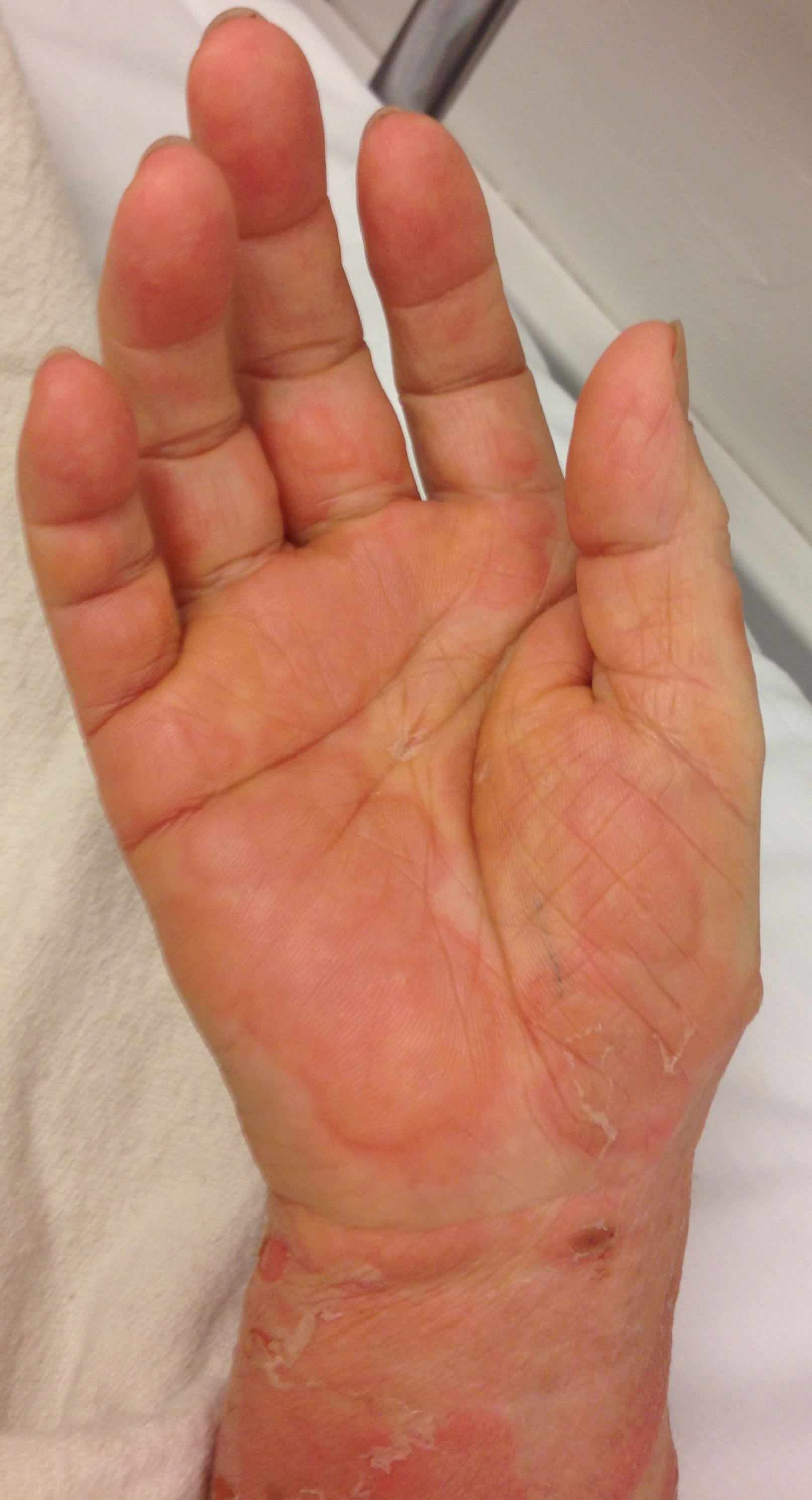 Tense Bullae and Urticaria in a Woman in Her Sixties