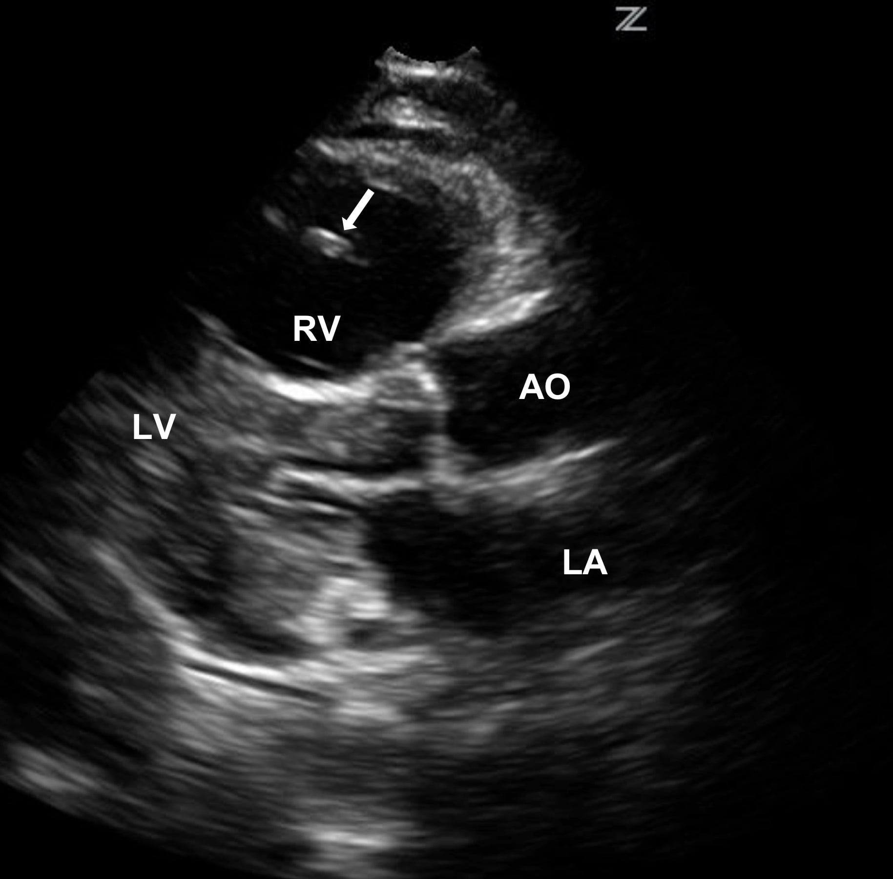 Bedside Echocardiography for Undifferentiated Hypotension: Diagnosis of a Right Heart Thrombus