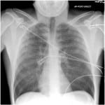 chest radiography