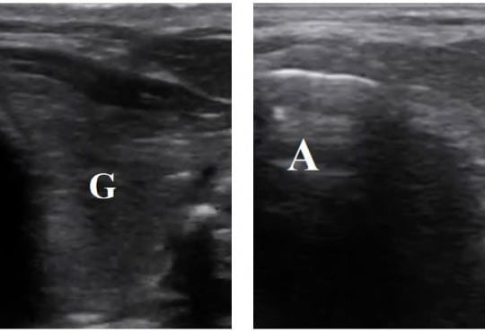 Accuracy of a Novel Ultrasound Technique for Confirmation  of Endotracheal Intubation by Expert  and Novice Emergency Physicians