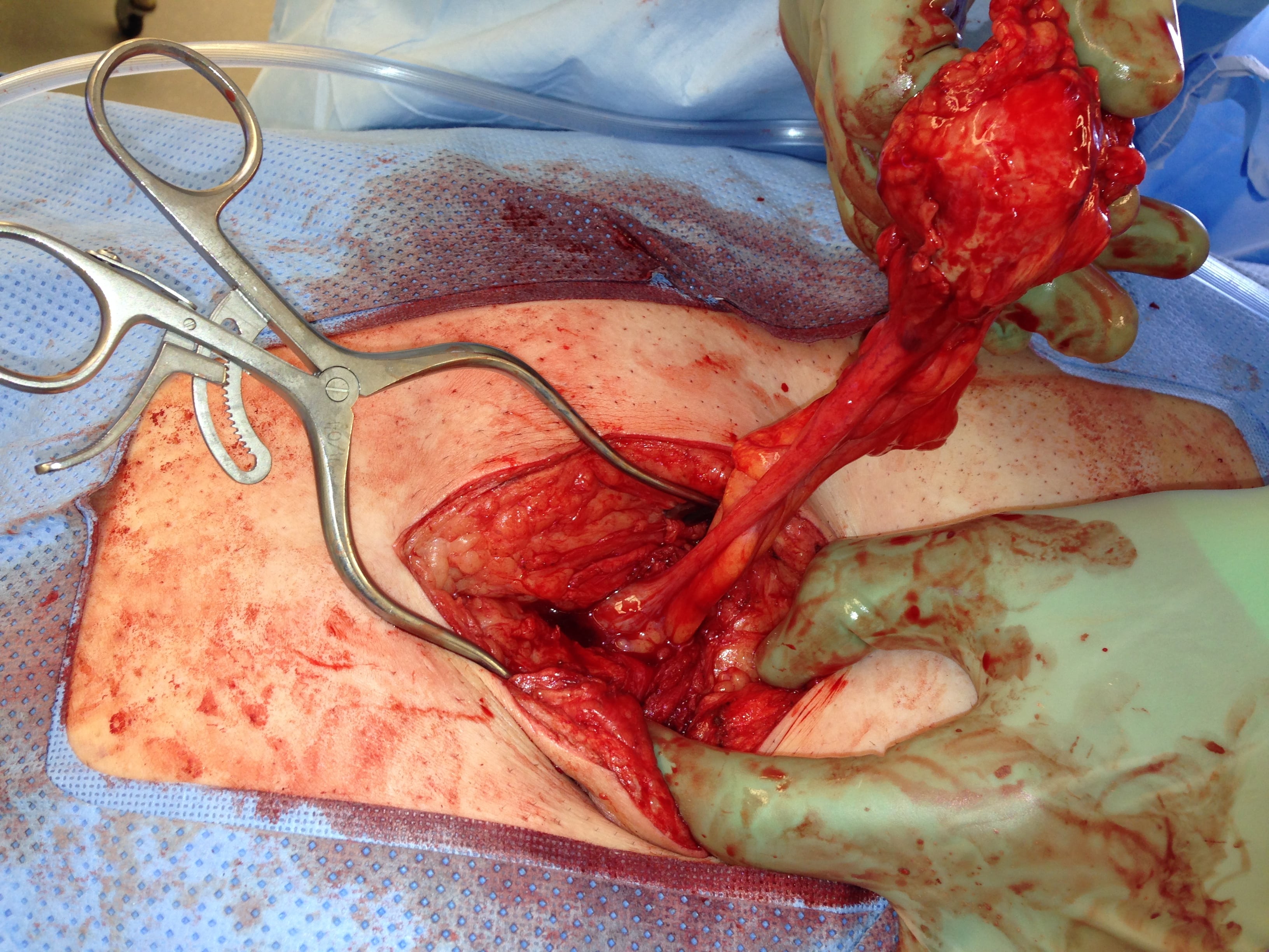 A Gut Feeling: An Extremely Rare Case of Missed Appendicitis