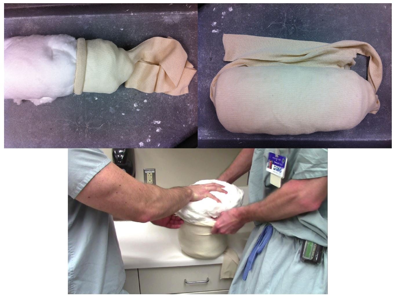Low-Cost Alternative External Rotation Shoulder Brace and Review of Treatment in  Acute Shoulder Dislocations