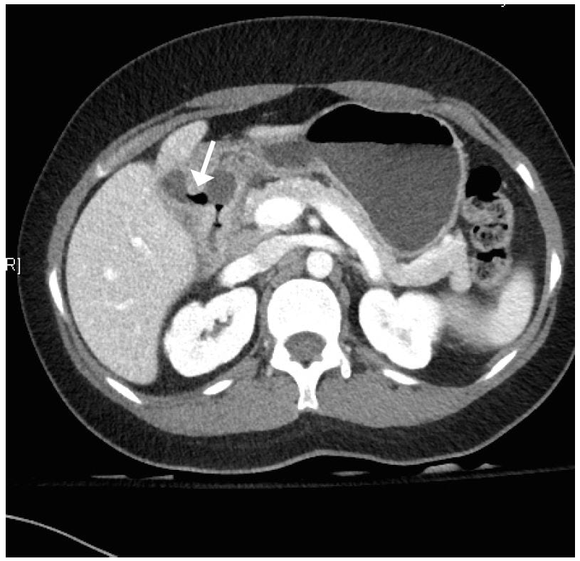 Delayed Diagnosis of Gastric Outlet Obstruction  from Bouveret Syndrome in a Young Woman