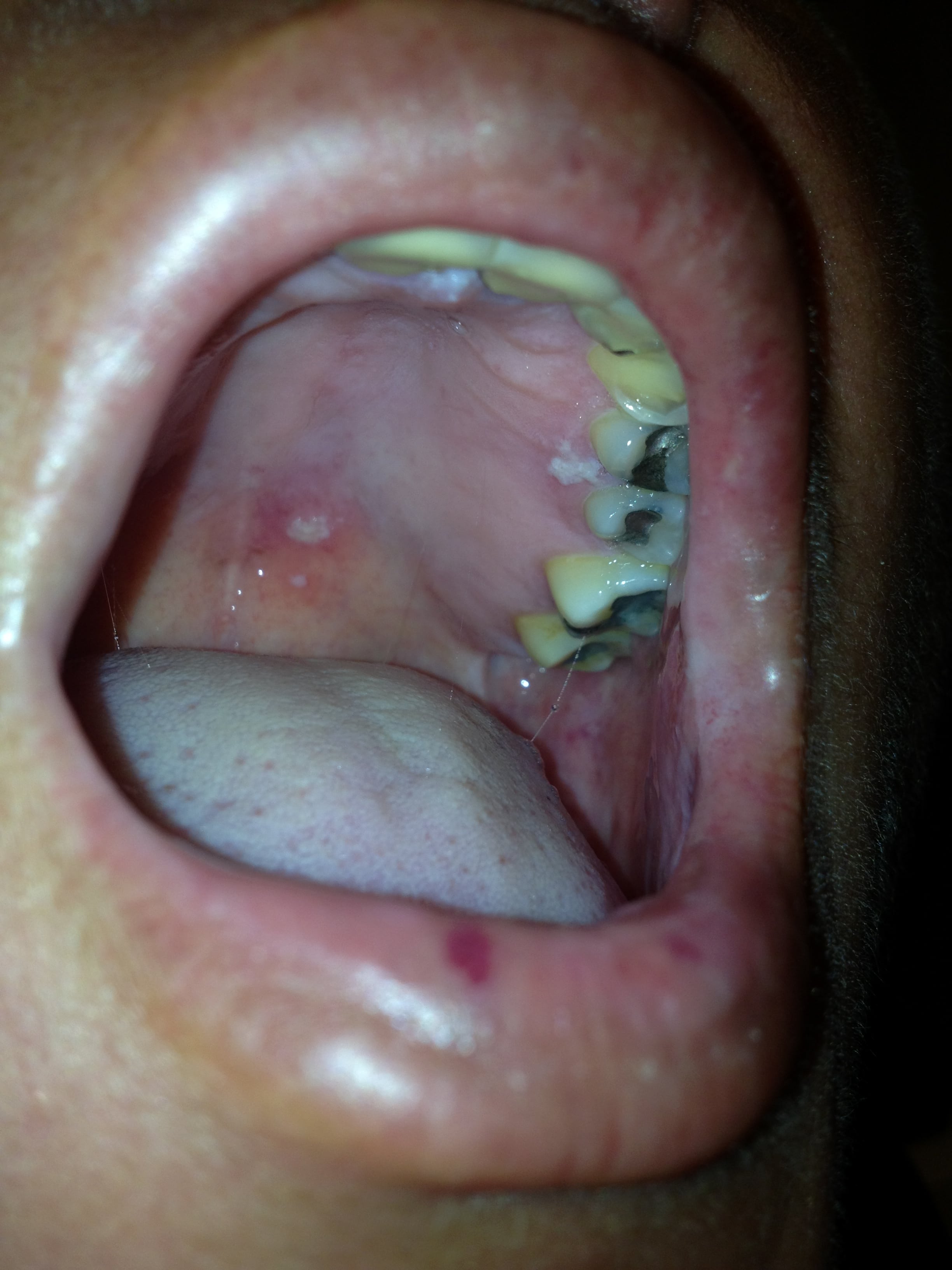 Herpes Zoster Ophthalmicus Extending To The Palate The Western 