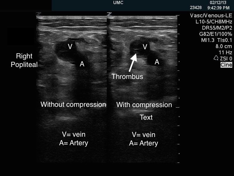 Half-dose Alteplase for Sub-massive Pulmonary Embolism Directed by Emergency Department Point-of-care Ultrasound